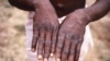 FILE - This handout photo provided by the Centers for Disease Control and Prevention was taken in 1997 during an investigation into an outbreak of monkeypox, which took place in the Democratic Republic of the Congo.