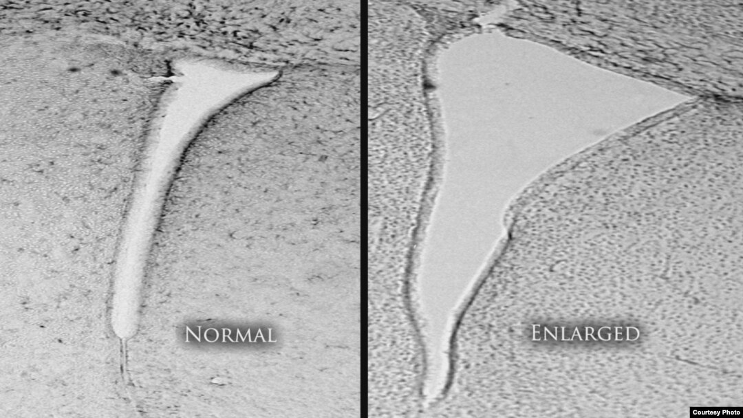 A mouse brain that was exposed to polluted air shows an enlarged lateral ventricle (right) compared with a mouse whose air was clean and filtered. (University of Rochester Medical Center)
