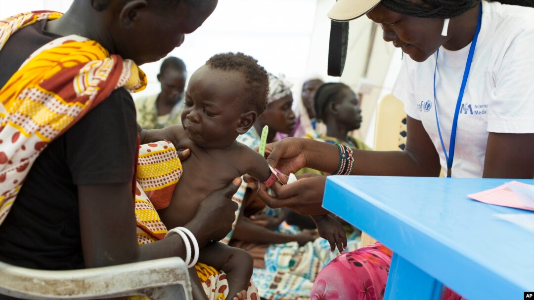FILE - In this photo of Friday, July 25, 2014, a child with suspected malnutrition is examined at IMC nutrition program clinic in Malakal, South Sudan. Researchers said this week that one-third of young children living in developing nations are failing to meet basic mental development milestones.