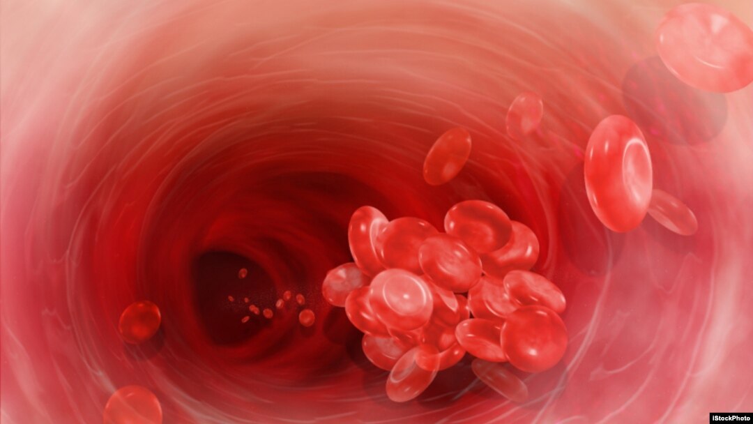 blood clot