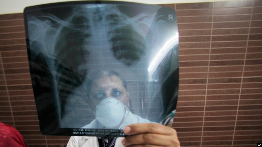 FILE - A physician examines an X-ray picture of a tuberculosis patient.